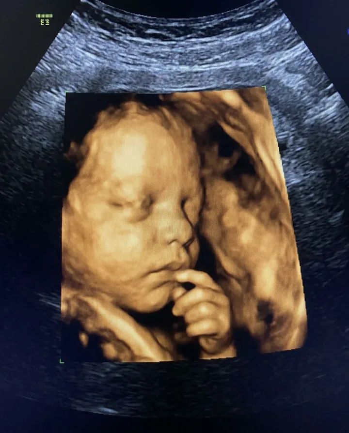 Ecografía 4D de perfil de un bebé chupándose el dedo